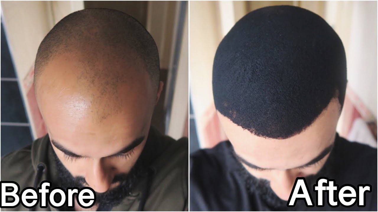 I GREW MY HAIR BACK!! - How I MIRACULOUSLY Reversed My Hair Loss - YouTube