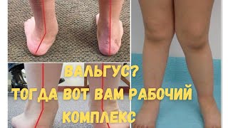 КАК ЛЕЧИТЬ ВАЛЬГУС?/ РАБОЧИЕ УПРАЖНЕНИЯ/ СУПЕР ЭФФЕКТ