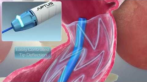 Endovascular Staple Video - Heli FX Endoanchors
