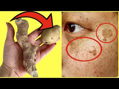 Shocking 😮She Wiped the Dark Spots Off Her Face with Potatoes and Ginger in Just 20 Minutes