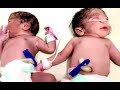 Newly Born Twin Babies For Ivf Couple At Dr PADMAJA FERTILITY Center(IVF & Surrogacy), Hyderabad