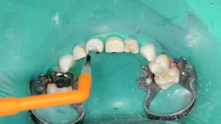 Rebuilding an upper primary ante. tooth using a SC, voiceover US