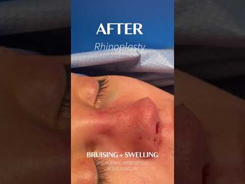 Video thumbnail: Closed Scarless Rhinoplasty + Septoplasty procedures. · Albert Plastic Surgery New York