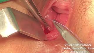 Dr Porwal’s Surgery for Recto Vaginal Fistula | Rare complication of LHP MIPH | Vagina layers | Anus