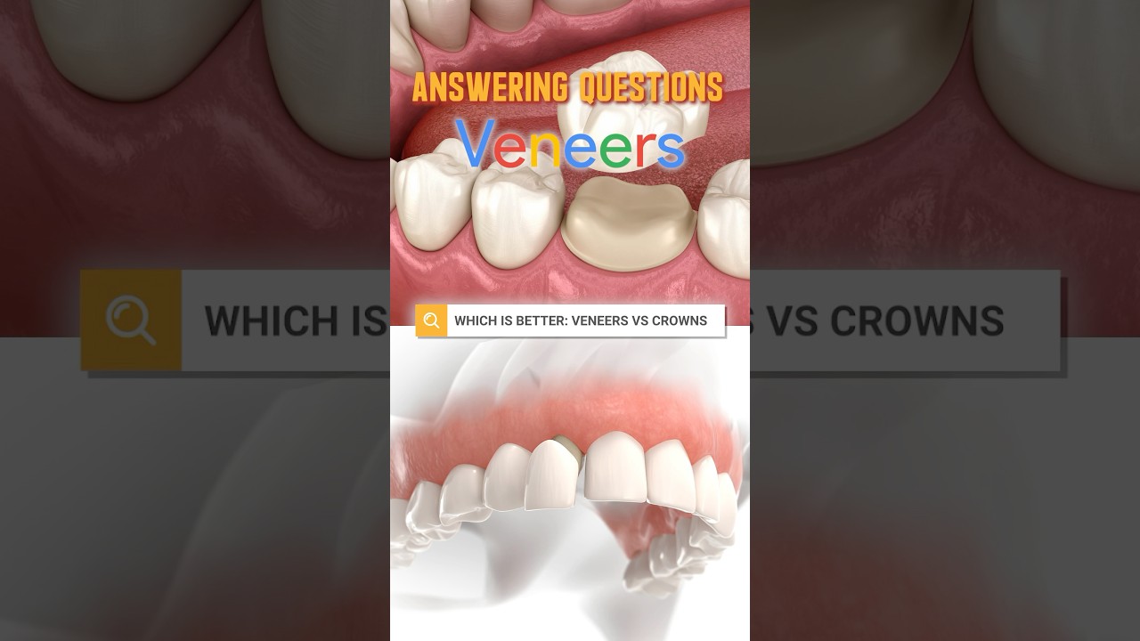 Are Veneers or Crowns Better? - Dentist answers!🤔 