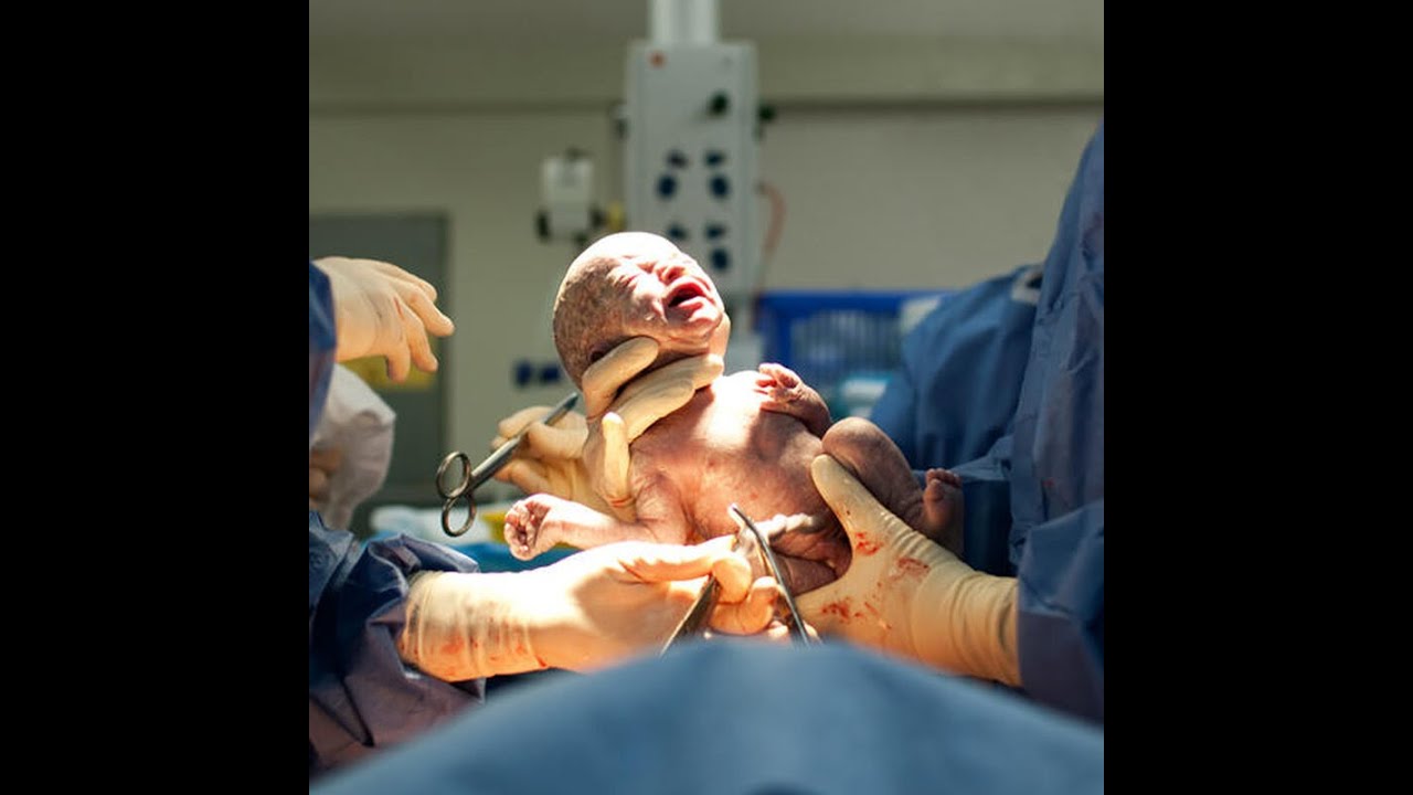 Кесарево-сечение. Последствия и устранение. - YouTube