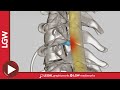 Anterior Cervical Discectomy and Fusion C5 C6 3D Surgery Animation