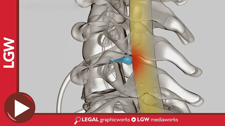 Anterior Cervical Discectomy and Fusion C5 C6 3D Surgery Animation