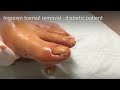 Ingrown toenail removal - diabetic patient