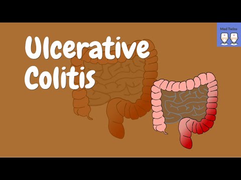 Ulcerative Colitis