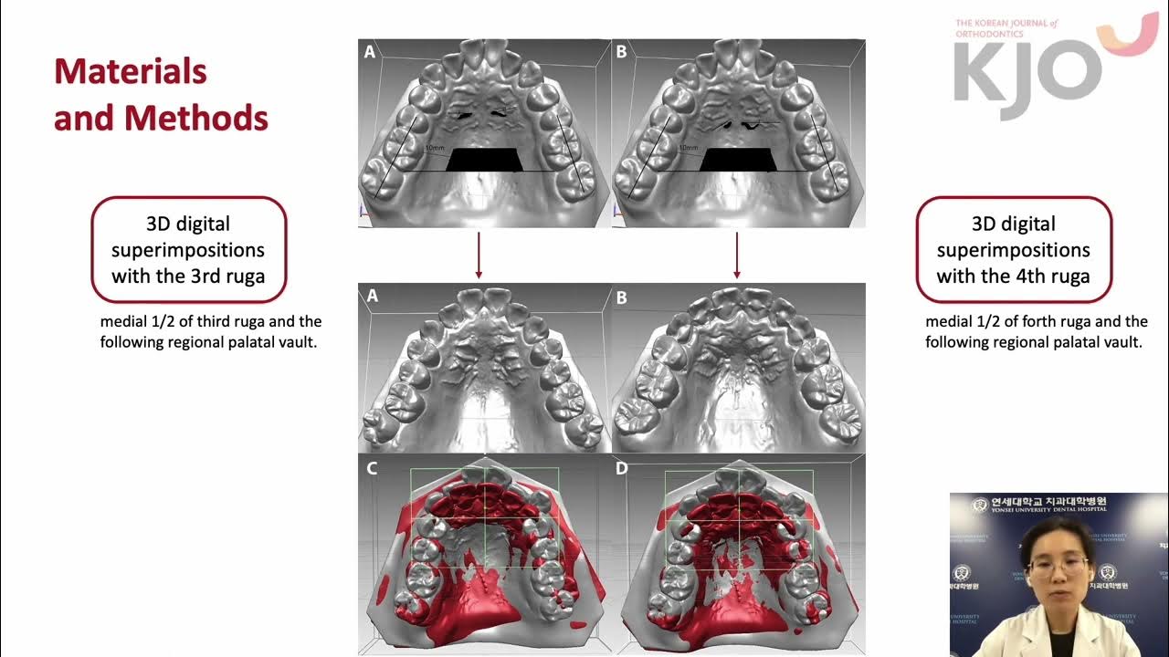 Model superimpositions in patients with maximum anterior tooth