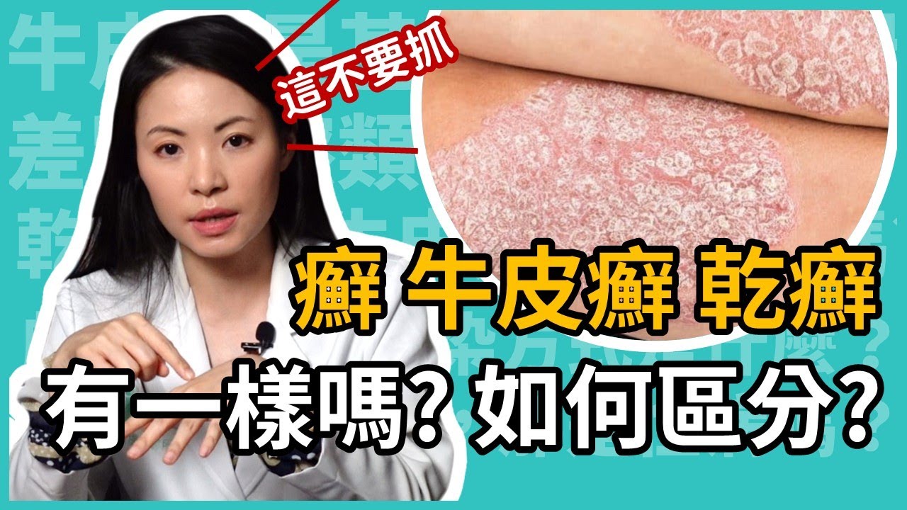 癬、乾癬、牛皮癬到底有什麼不一樣?乾、癢、紅腫就是癬嗎?皮膚科林昀萱醫師教你聰明辨識! - YouTube