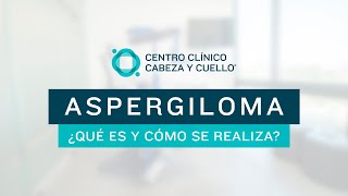 Aspergiloma ¿Qué es y cómo se realiza?