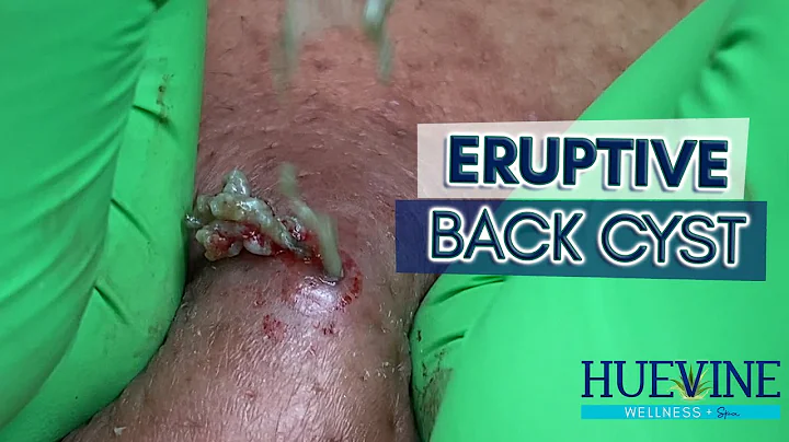 An Eruptive, Massive Back Cyst That Took Us 1.5 Ho...