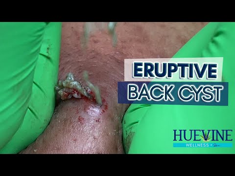 An Eruptive, Massive Back Cyst That Took Us 1.5 Hours | HueVine