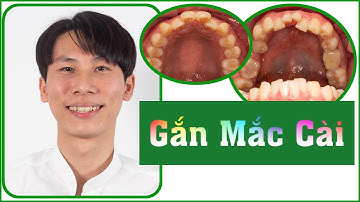 Gắn mắc cài niềng răng chỉnh sửa hàm răng lệch lạc, khấp khểnh, chen chúc.