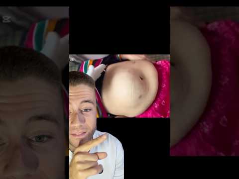 Hernia abdominal ventral