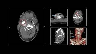 Neuro Trauma IV | Interesting Radiology Cases
