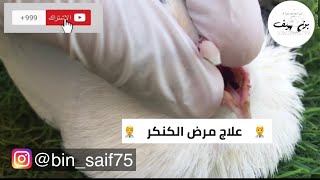 علاج مرض الكنكر??.