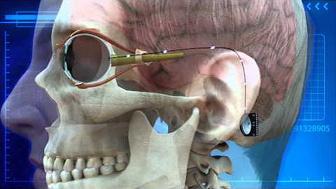 Man fitted with first-ever bionic eye, sees wife for the first time