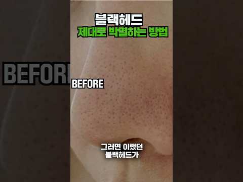 블랙헤드 관리법