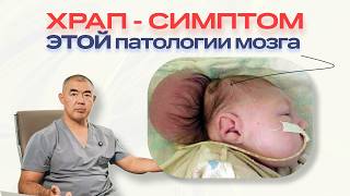 видео: Аномалия Киари (мальформация Арнольда–Киари) — симптомы, диагностика и лечение | мнение нейрохирурга картинка: Аномалия Киари (мальформация Арнольда–Киари) — симптомы, диагностика и лечение | мнение нейрохирурга
