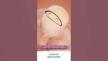 What is Deep Brain Stimulation (DBS)? ↪ 3D Medical Animations #(DBS) #DeepBrainStimulation #Shorts