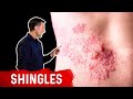 Shingles Natural Relief mp3