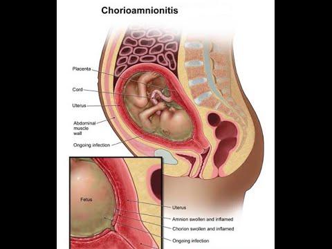 ቪዲዮ: Chorioamnionitis እንዴት እንደሚታወቅ?