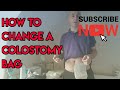 How to change a colostomy stoma bag