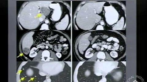 Demystifying Medicine 2013 - Genomic Paradigm for Cancer Diagnosis and Therapy: Melanoma