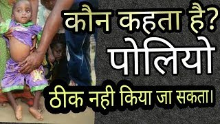 polio can be cured completely by ayurvedahow to cure polio permanentlyपोलियो को करें जड़ से खत्म
