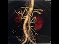 Renal CTA || Toshiba 64 slice