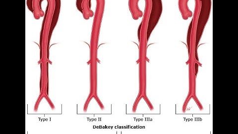 Aortic dissection - Usmle step 1 pathology case based discussion