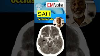 Subarachnoid Hemorrhage sah Due To Ruptured Cerebral Aneurysm