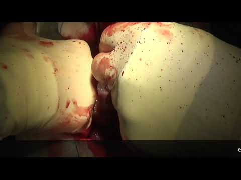 Video: Tumor Af Thymus Hos Hunde