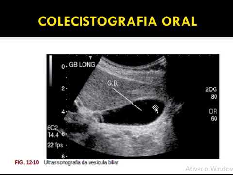 Vídeo: Em preparação para um colecistograma?