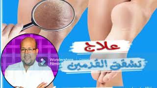 تخلصي من تشقق القدمين مع الدكتور عماد ميزاب