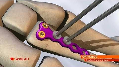 ORTHOLOC™ Forefoot Fracture System Animation