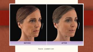 What Is Juvederm Voluma Treatment Like?