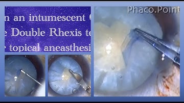 How to perform the "Double Rhexis" in an intumescent cataract and proceed with phacoemulsification.