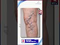 Avis Vascular Centre | Non Surgical Treatment | Best Varicose Veins Treatmen𝐭 | Avis Hospitals | RTV
