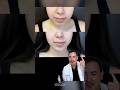 WHY WOULD YOU WANT TO LOOK OLDER?! Chin Augmentation 🤔 Dr. Johnson C. Lee | Beverly Hills, CA