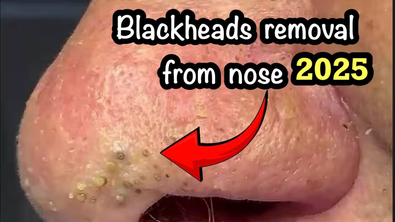 Blackheads new 2025 today |Removing blackheads from nose|  Removal