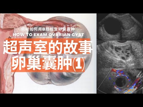 卵巢囊肿（1）：为什么会得卵巢囊肿/常见生理性卵巢囊肿/症状有哪些/B超是如何检查的/囊肿出血和扭转/预防和治疗【Ultrasound Room】Ovarian Cyst (1)
