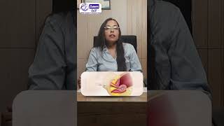 Copper T यूट्रस में फंस गई? Hysteroscopy से निकलती है! #Shorts #CopperT #WomensHealth