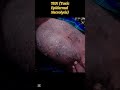 #toxicepidermalnecrolysis #dermatology    ( Details in comment)