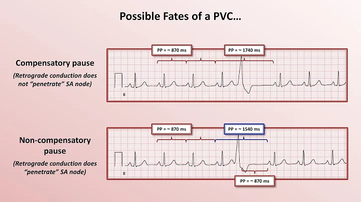 Advanced EKGs - PACs and PVCs (i.e. premature beats)