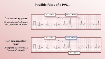 Advanced EKGs - PACs and PVCs (i.e. premature beats)