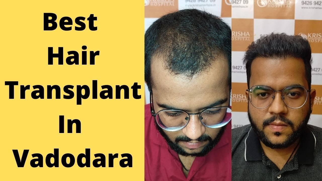 Get Natural Looking Hair with a Hair Transplant in Vadodara